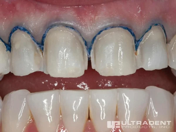 Ultradent Fischer's Ultrapak Packer Serrated - Image 3