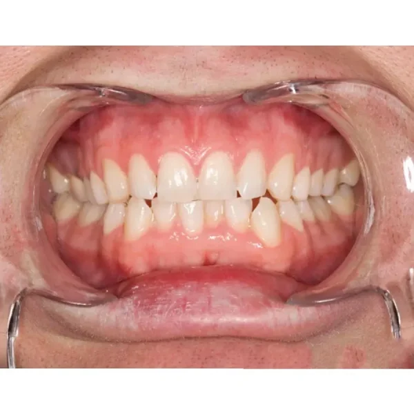 Ultradent Kleerview Retractors - Image 2