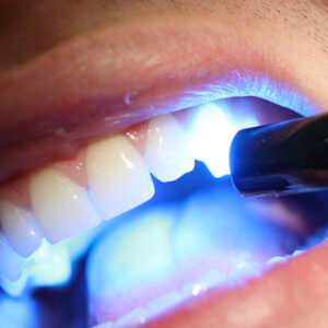 Sara Dental - Laser Teeth Whitening