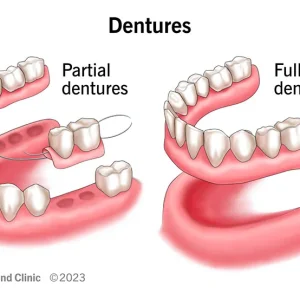 Dentures