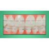 ECC Irish Clear Self Ligating Bracket Kit 022 - Demon Type - Image 2