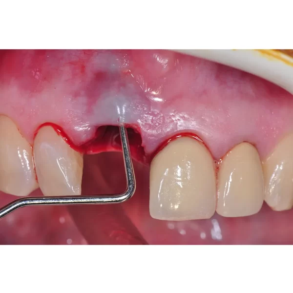 Bone Curette Hemingway #CH877 #4 - Image 4