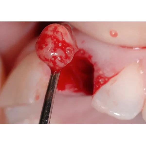 Bone Curette Hemingway #CH877 #4 - Image 3