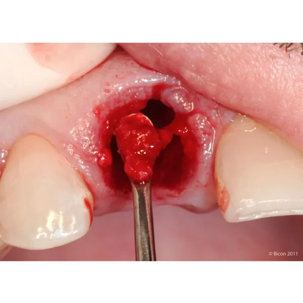 Surgical Curette Lucas #CL86 #4 - Image 2