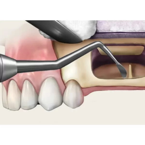 Sinus Lift Instrument Hollow Handle No. 6 - Image 2