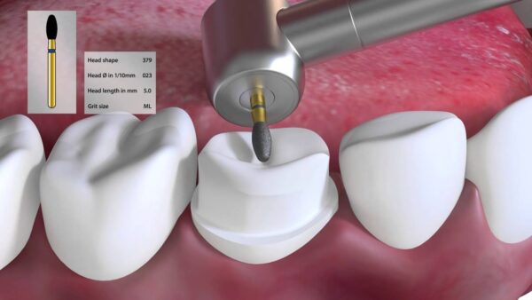 Coltene Diatech Crown Preparation Kit - Image 3