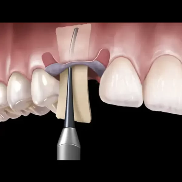 Membrane Placement - Image 2