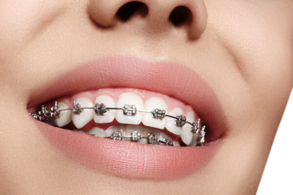 Orthodontics Braces Treatment