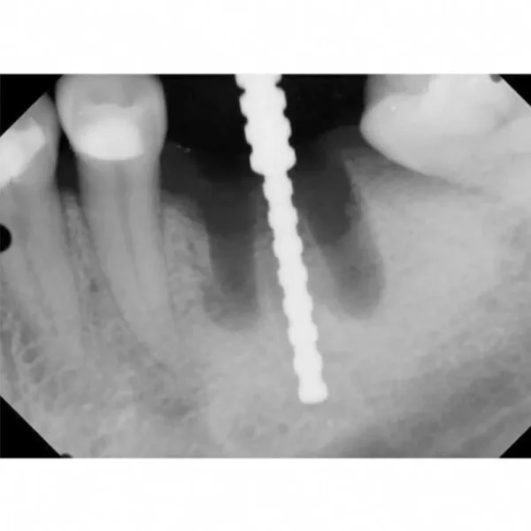 Julldent Parallel Pins For Implant - Image 2
