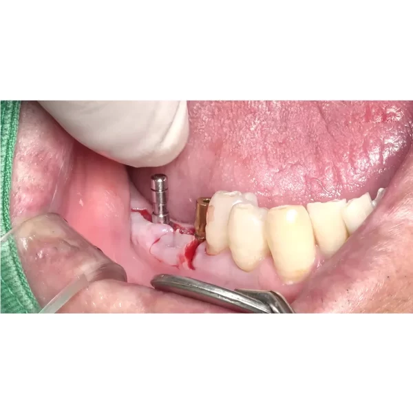 Julldent Parallel Pins For Implant - Image 3
