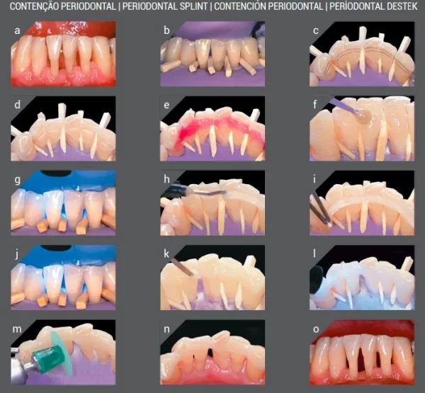 Angelus Interlig Single Patient Strip - Image 3