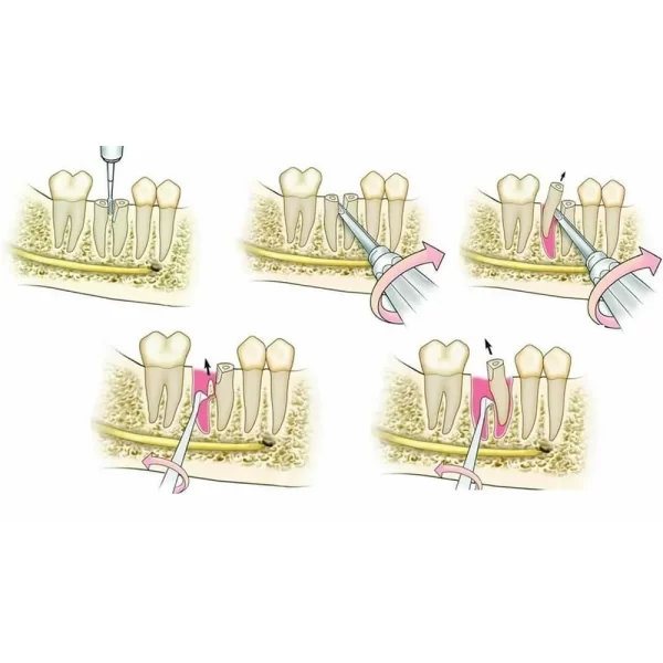 Root Elevator Standard In Pouch RESP9 - Image 2