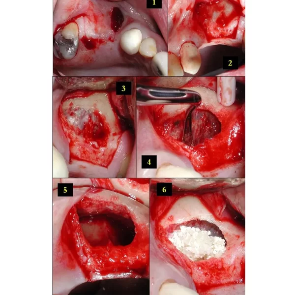 Sinus Lifting Instruments In Pouch - Image 2