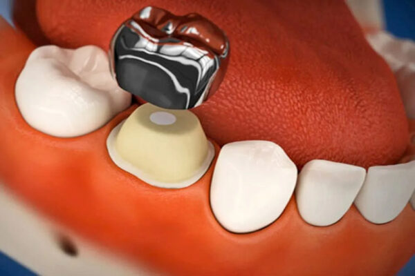 3M ESPE SS Crown Primary Molar Crown-D (1st molar) - Image 2
