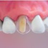 Tor Vm Transparent Crowns 64 Pcs - Anterior No. 1.910 - Image 2