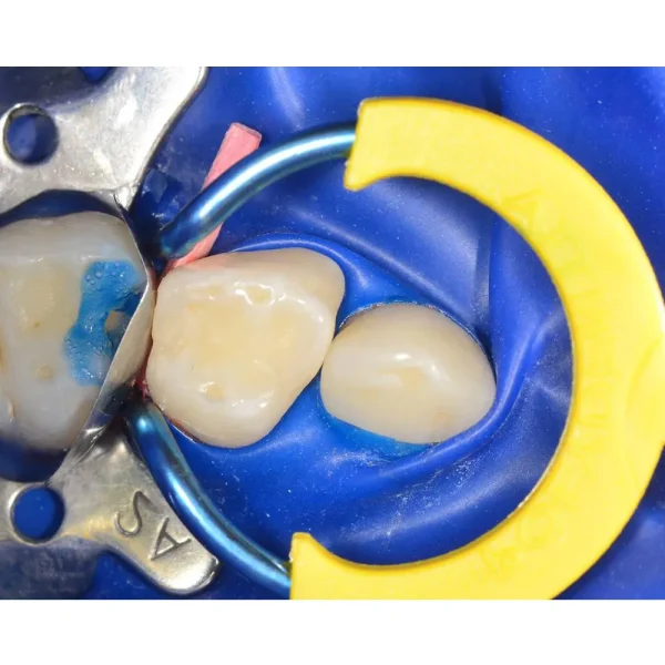 Polydentia myJunior Paediatric Sectional Matrix System Kit - Image 3