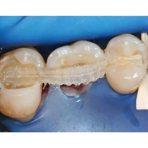 Fiber Splint Ortho Evolution (3 Layer 2mm X 60 cm With 5 Clips) - Image 3
