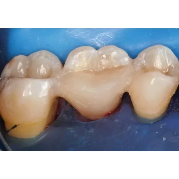 Fiber Splint Ortho Evolution (3 Layer 2mm X 60 cm With 5 Clips) - Image 2